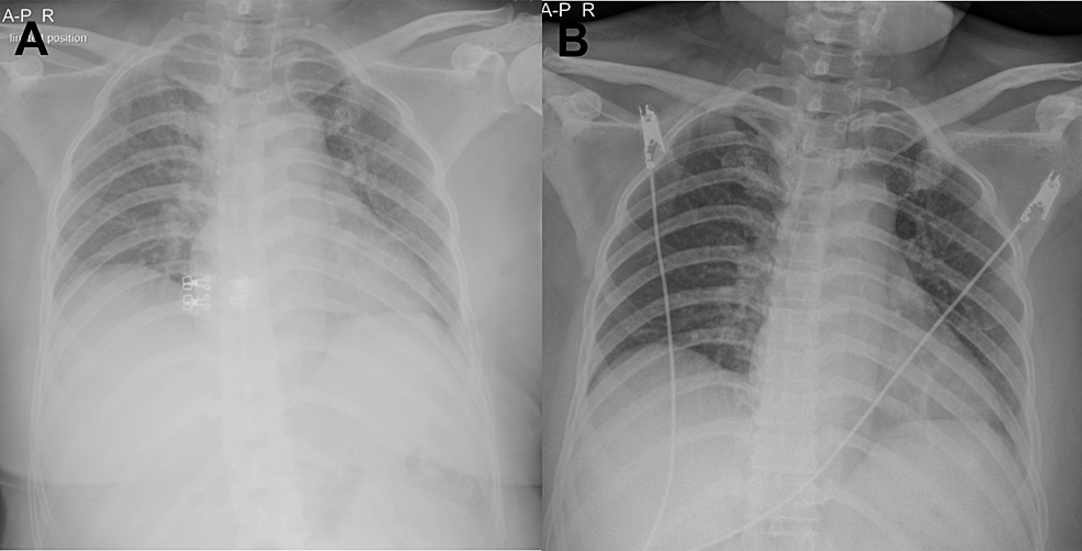 Chest-X-rays-During-Treatment-Course