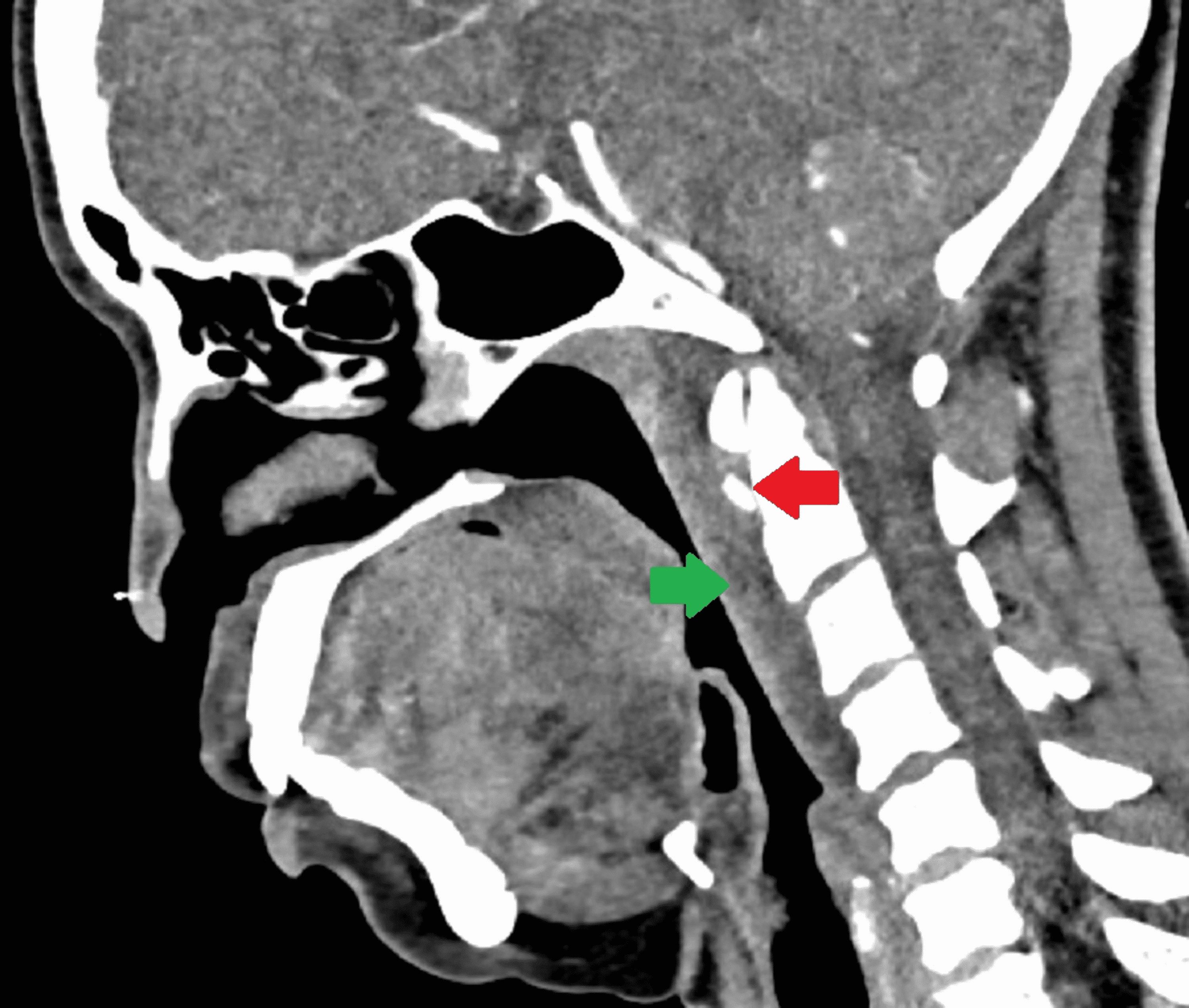 Cureus | Acute Calcific Tendinitis Of The Longus Colli Muscles: An ...