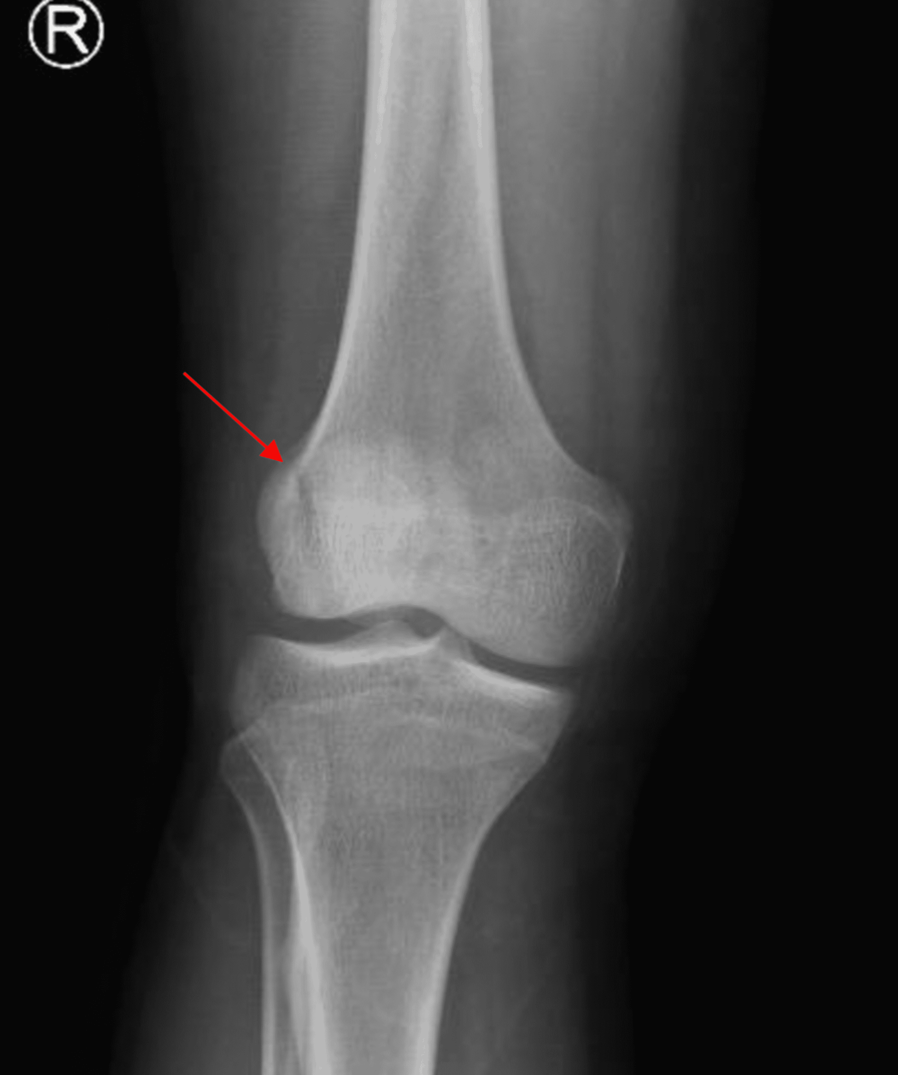 Cureus | Vertical Patella Fracture Fixed by Plate and Screws With Bone ...