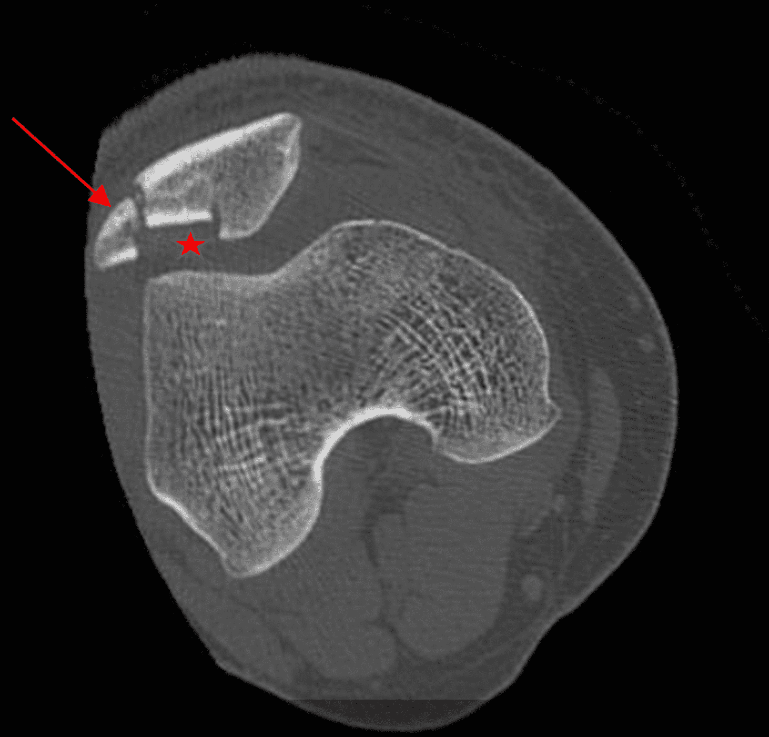 Cureus Vertical Patella Fracture Fixed by Plate and Screws With Bone