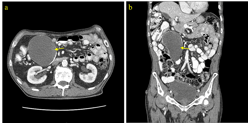CT-abdomen-and-pelvis-with-contrast-(Case-2).-a)-Axial-view-and-b)-coronal-view-showing-a-cystic-lesion-with-peripheral-calcification-in-the-right-abdomen.-Subsequent-exploratory-laparotomy-and-appendectomy-revealed-a-large-cystic-appendiceal-tumor.-Pathology-of-the-lesion-was-consistent-with-LAMN.