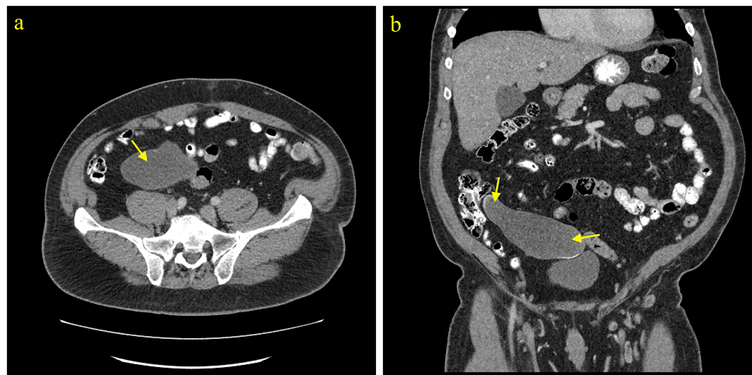 Cureus | Low-Grade Appendiceal Mucinous Neoplasm: A Case Series