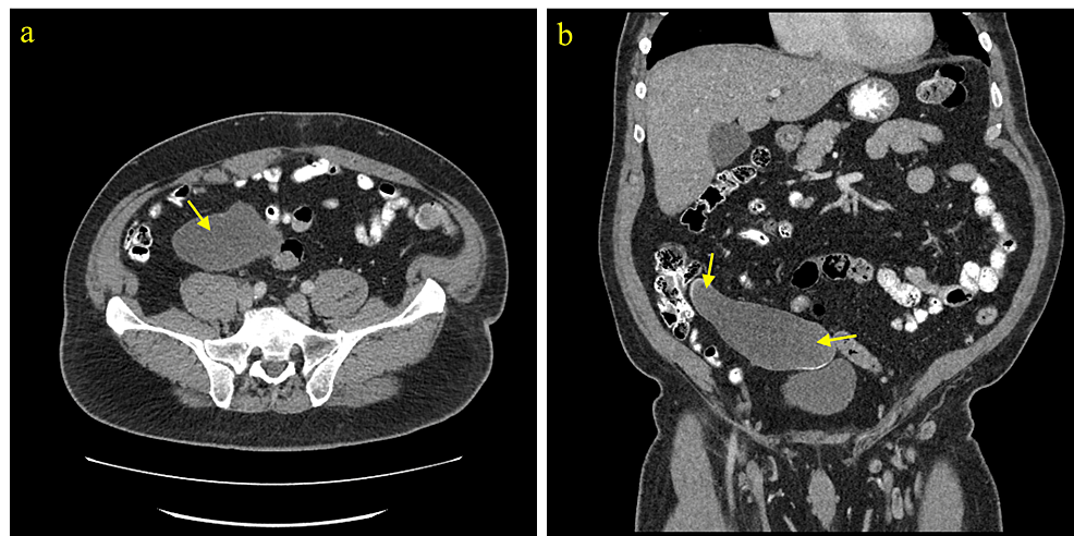 CT-abdomen-and-pelvis-with-contrast-(Case-3).-a)-Axial-view-showing-a-cystic-lesion-in-the-right-abdomen.-b)-Coronal-view-showing-a-RLQ-tubular-cystic-mass-with-heterogeneous-mural-calcifications.-Pathology-of-the-mass-showed-LAMN.-