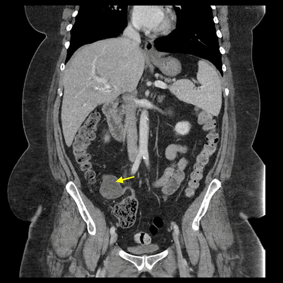 CT-abdomen-and-pelvis-with-contrast-(Case-5).-Coronal-view-showing-a-cystic-mass-in-the-distal-appendix.-Pathological-examination-of-the-mass-showed-LAMN.