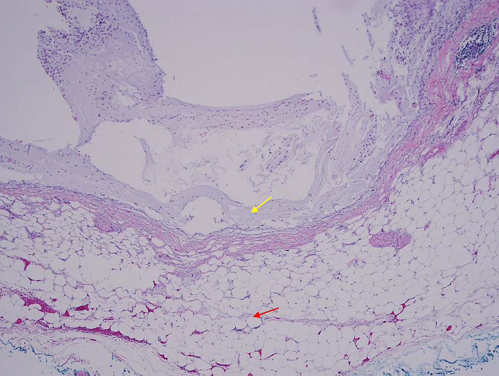A-microphotograph-shows-mucin-sitting-on-the-serosa-(yellow-arrow),-which-reached-there-by-dissecting-the-wall-(red-arrow-shows-subserosal-adipose-tissue---the-outer-wall-of-the-appendix).