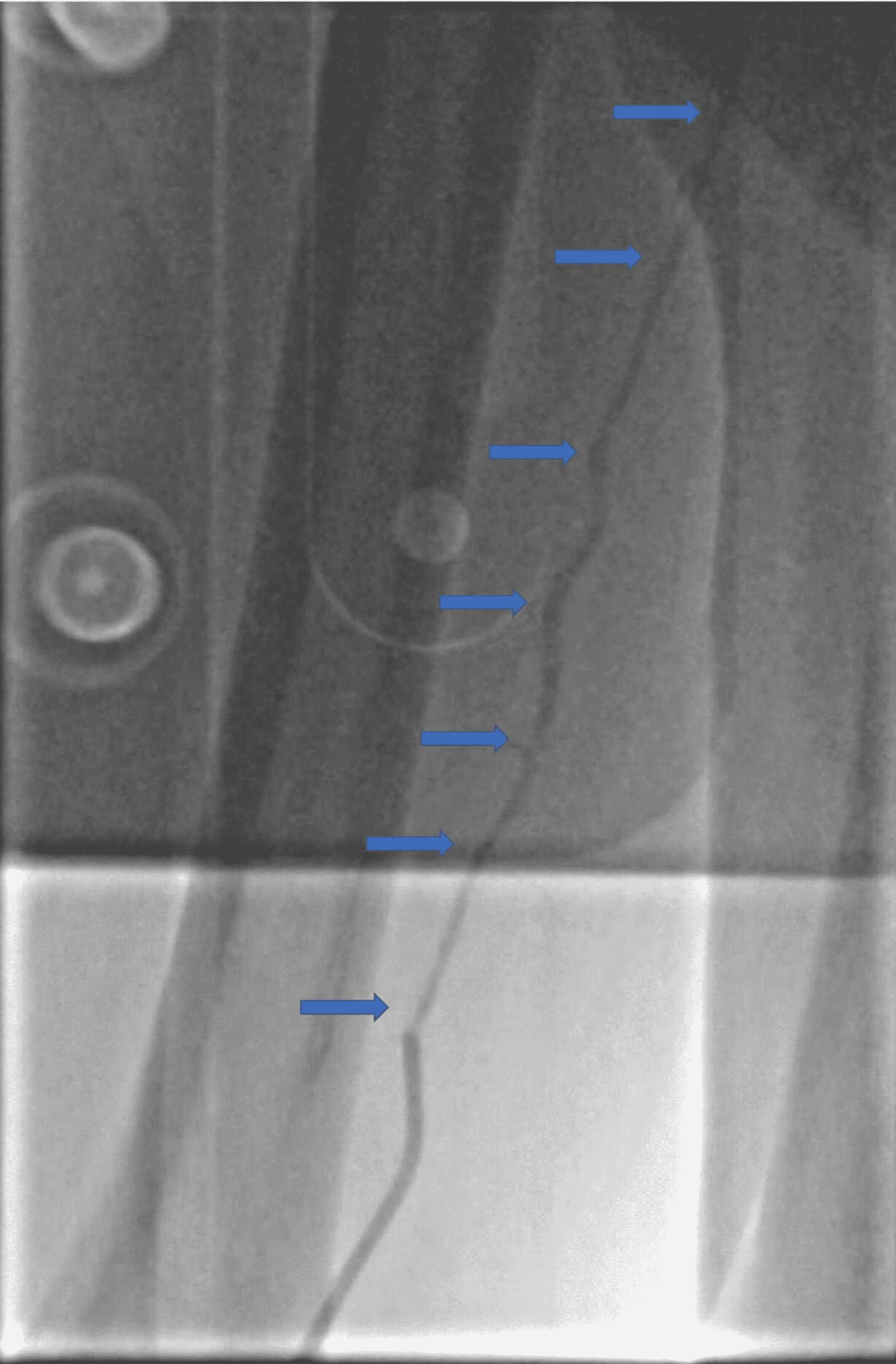 Cureus Can Tiger (TIG) Catheters Be a Solution to the Radial Artery