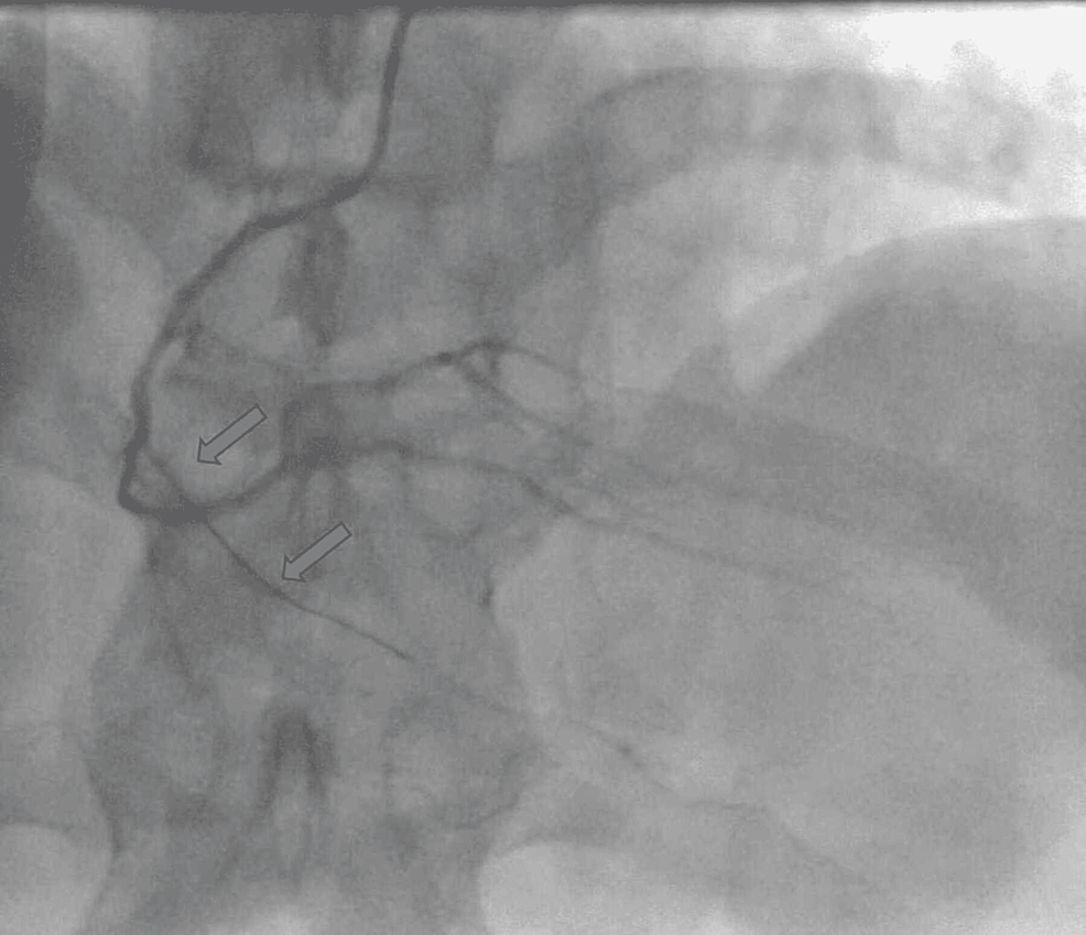 Cureus Can Tiger Tig Catheters Be A Solution To The Radial Artery Spasm Ras In Coronary