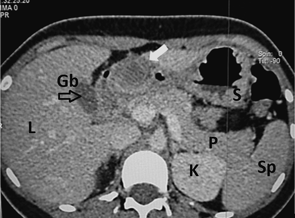 Axial-computed-tomography-(CT) -scan-of-the-abdomen.