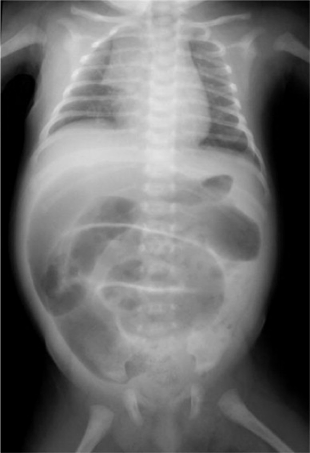 Abdominal-plain-X-ray-shows-a-generalized-distention-of-the-loops-of-the-large-intestine.-Typical-findings-of-Hirschsprung-disease-were-seen.-(Consent-was-obtained-to-publish-this-radiograph).