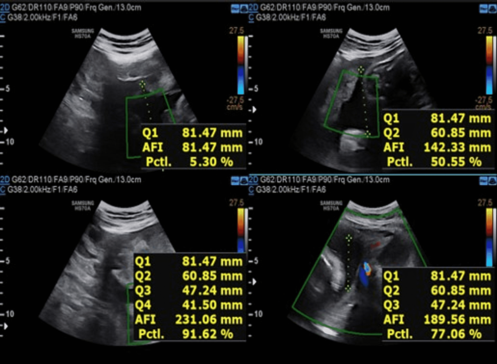 cureus-association-and-correlation-between-amniotic-fluid-index-and