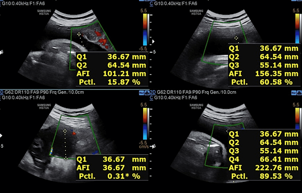 Cureus Association and Correlation Between Amniotic Fluid Index and