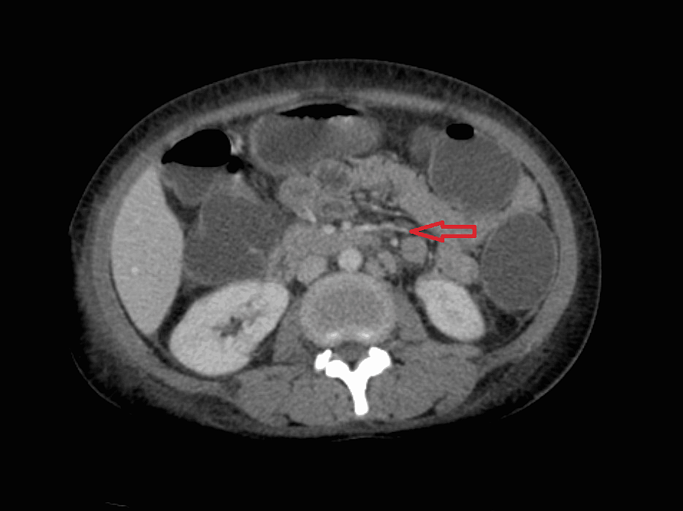 CECT-of-the-abdomen-revealing-para-aortic-and-mesenteric-adenopathy