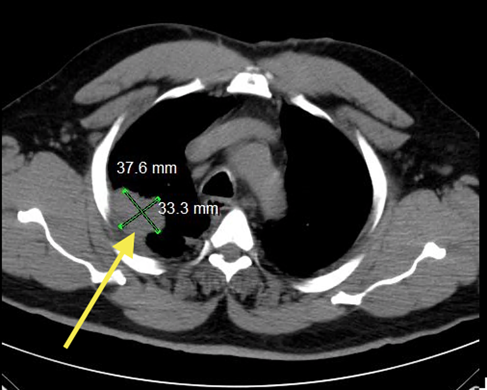Computed-tomography-(CT)-of-the-patient’s-chest-illustrating-a-pleural-based-density-in-the-right-upper-lobe-measuring-3.3-cm-x-3.7-cm-(yellow-arrow).-