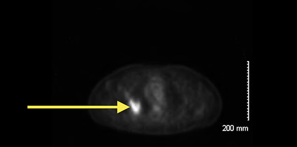 Positron-emission-tomography-(PET)-of-the-patient’s-chest-illustrating-spiculated-hypermetabolic-mass-in-the-right-upper-lobe-of-the-lung-consistent-with-primary-lung-tumor-(yellow-arrow).-