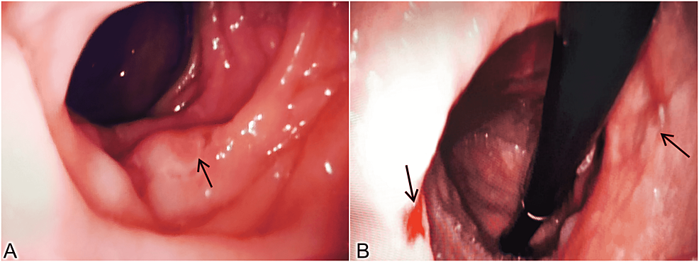 Post treatment - upper GI endoscopy - images - show - ulcers - solution.  From both-healing-ulcer-sites