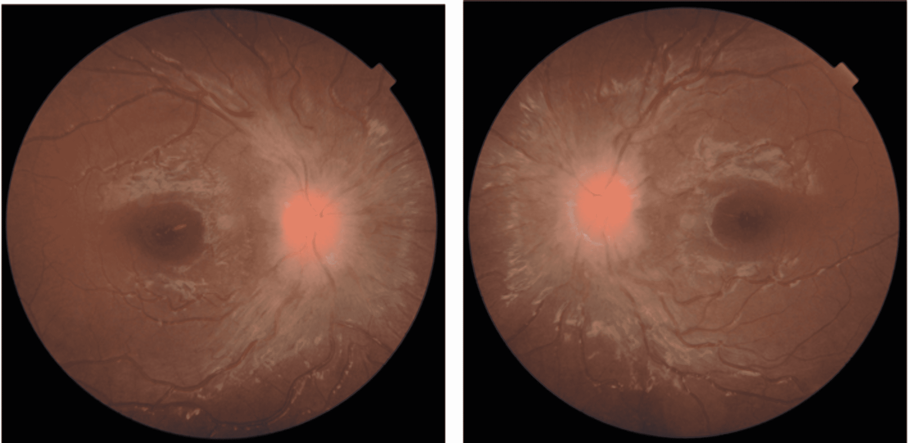 Cureus | Bilateral Papilledema and Right Esotropia as an Initial ...