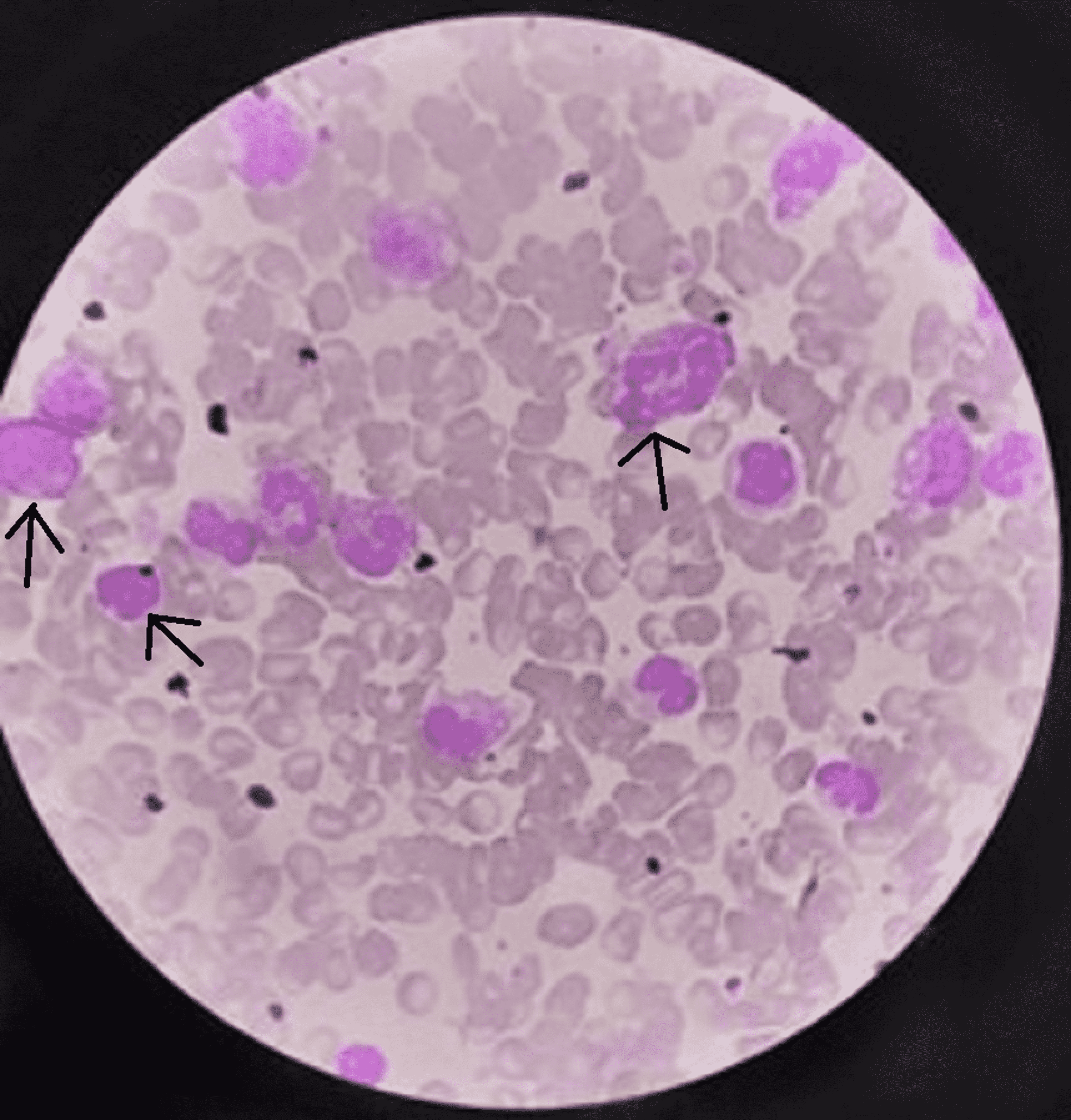 Cureus | An Unusual Presentation of Neonatal Sepsis as ...