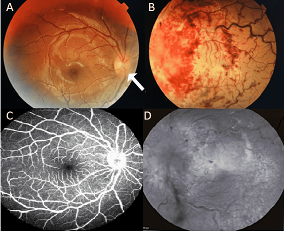 (A)-Fundus-image-showing-the-right-optic-disc-margin-with-a-blurred-nasal-margin-(arrow)-and-(B)-generalized-retinal-hemorrhages-with-total-obscuration-of-the-left-optic-disc-margin,-with-dilated-and-tortuous-retinal-veins.-(C)-Fundus-fluorescein-of-the-right-eye-showing-a-hot-disc.-(D)-Fundus-fluorescein-angiography-of-the-left-eye-showing-total-absence-filling-of-the-choroid,-retina-artery,-and-vein-for-up-to-seven-minutes.