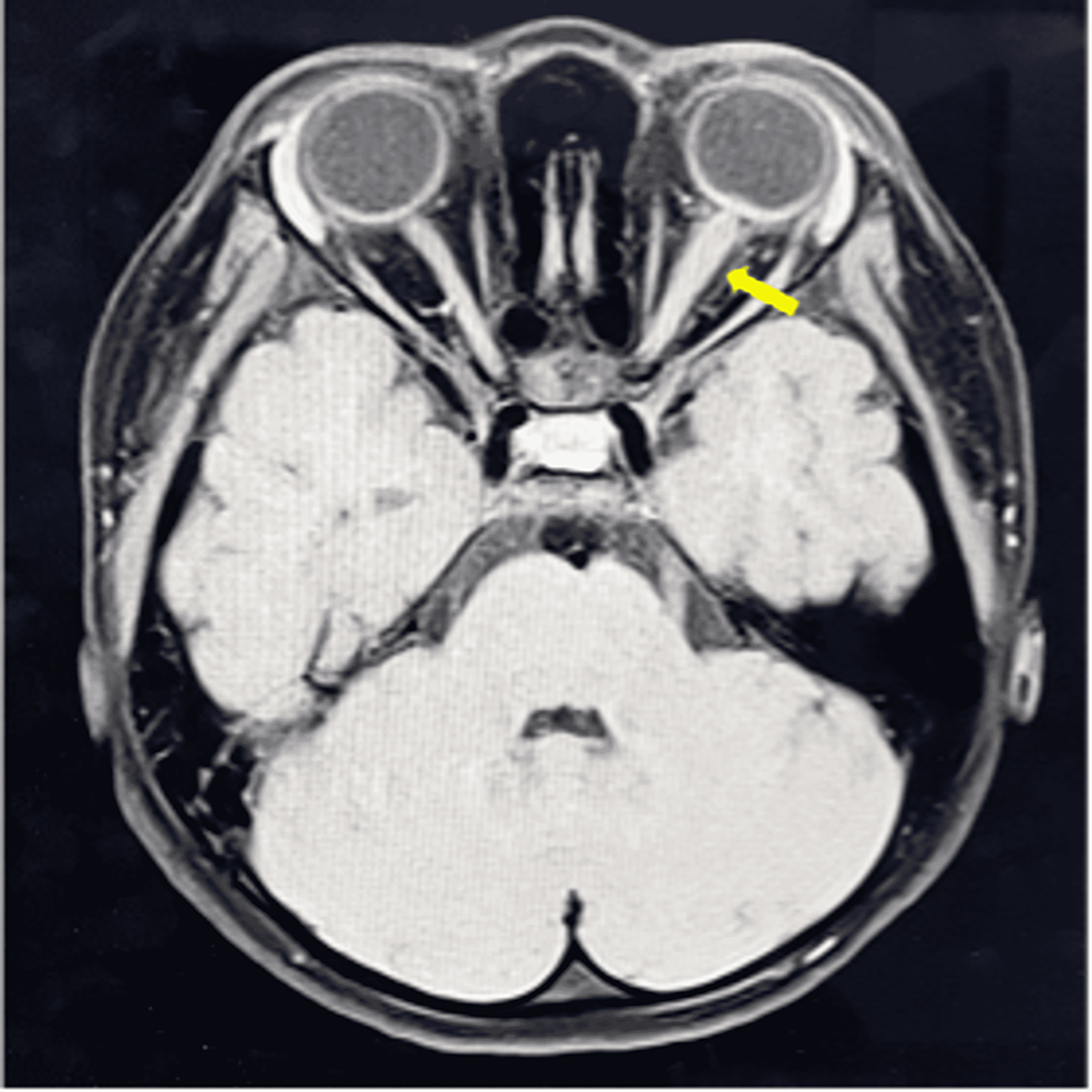 MRI-T1-weighted-brain-and-optic-nerve-revealing-left-intraorbital-optic-nerve-thickening-(yellow-arrow)-associated-with-perineural-enhancement-and-intraconal-fat-involvement-on-DWI/ADC-(DWI/ADC-image-is-not-included-in-this-figure).