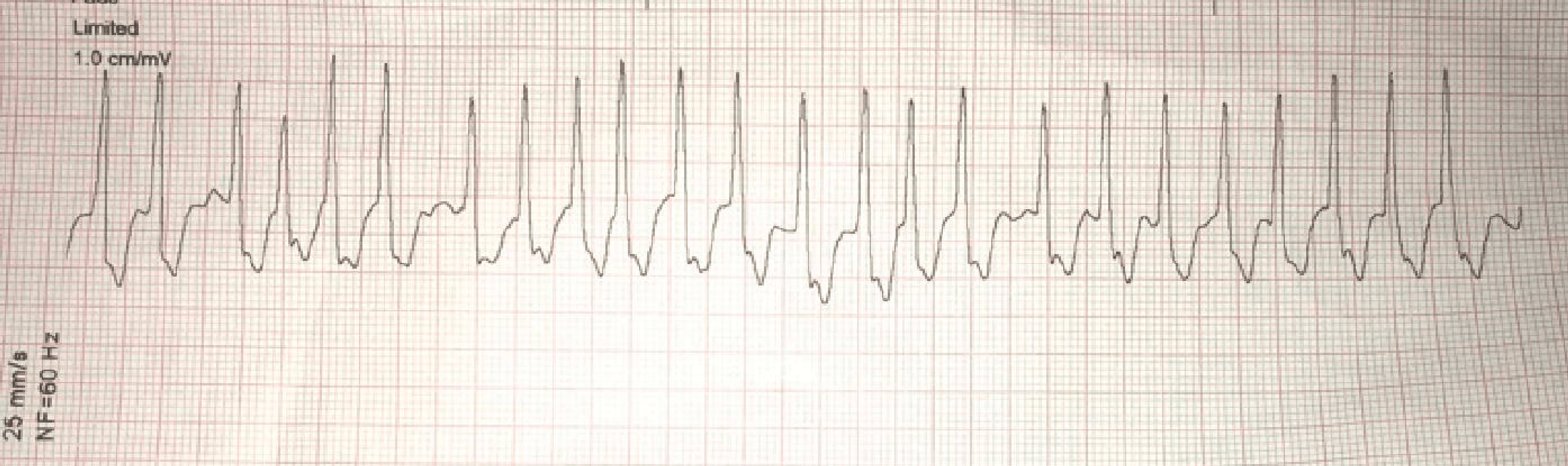 Cureus | Unusual Cause of a Cardiac Arrest in a Former African American  Collegiate Athlete