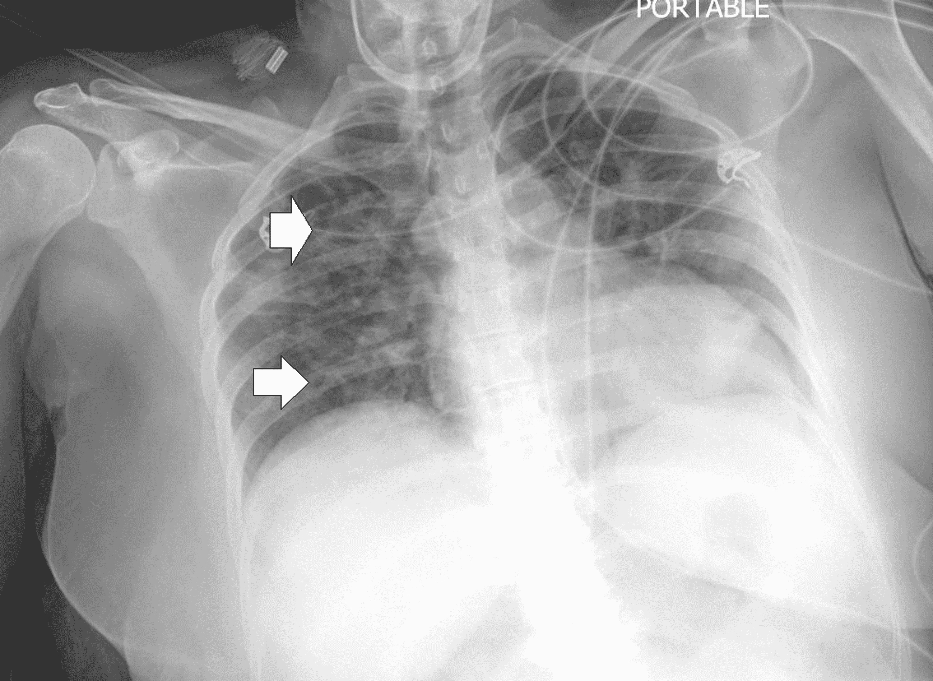 Cureus Retinal Vasculitis in a Patient With Mixed Connective Tissue