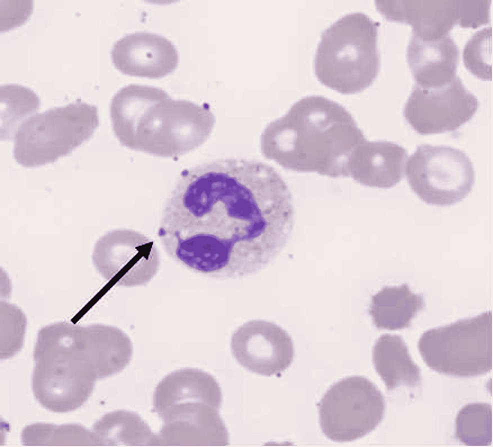 Peripheral-smear-on-the-day-of-admission.-Arrow-indicates-Döhle-bodies-in-neutrophils.