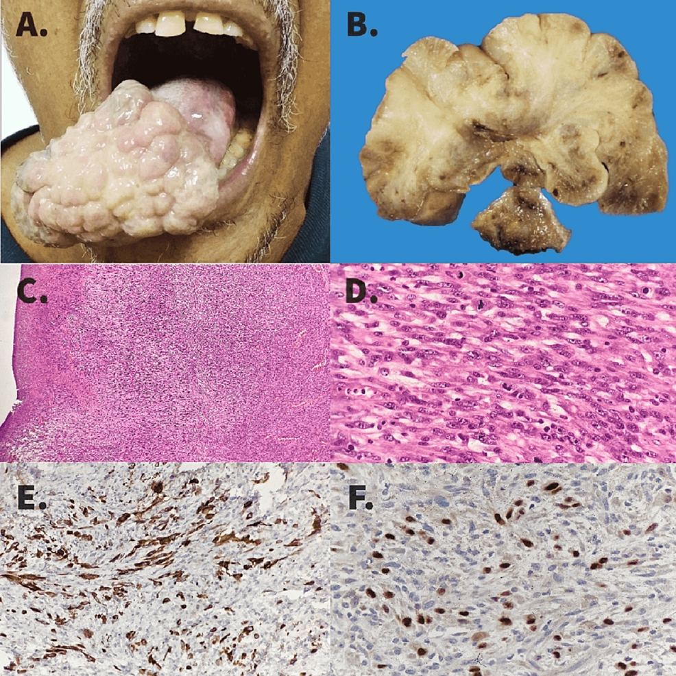 Cureus Second Primary Spindle Cell Carcinoma Of The Tongue A Rare 