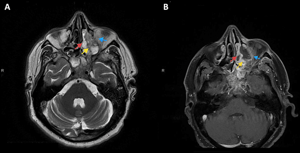 (A)-Axial-T2-sequence&nbsp;showing-thickened-hypointense-lesion-of-the-medial-wall-of-the-maxillary-sinus-(yellow-arrows),-orbital-floor-(blue-arrows),&nbsp;and-middle-turbinate-(red-arrows).-(B)-Axial-T2-fat-saturated-image-showing-no-enhancement-of-the-necrotic-medial-wall-of-the-maxillary-sinus,-orbital-floor,-and-middle-turbinate.