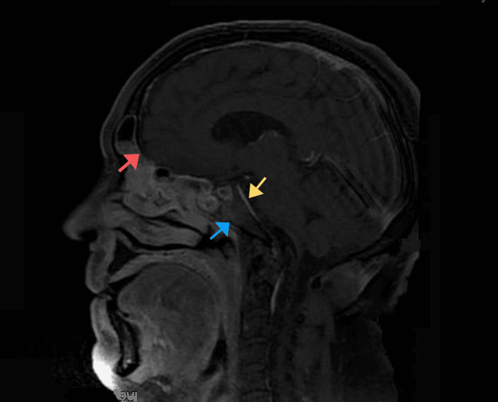 Sagittal-T1-fat-saturated-image-showing-abnormal-enhancement-of-the-anterior-surface-of-the-clivus-(blue-arrow),-the-dura-(red-arrow),-and-the-prepontine-cistern-(yellow-arrow).