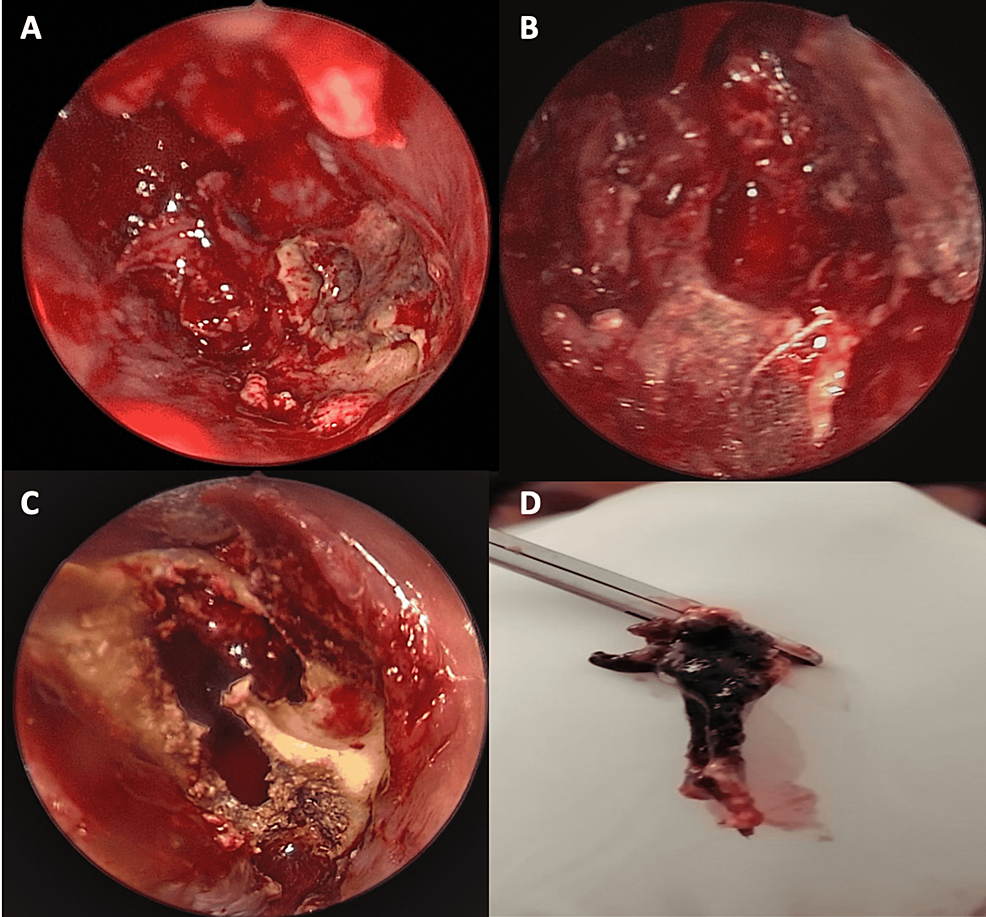 (A)-Gross-involvement-of-the-middle-and-inferior-turbinate.-(B)-Status-post-removal-of-the-middle-turbinate-and-debridement-of-the-necrotic-posterior-maxillary-wall.&nbsp;(C)-Open-maxillectomy-showing-necrotic-alveolar-bone.&nbsp;(D)-Resected-necrotic-inferior-turbinate.