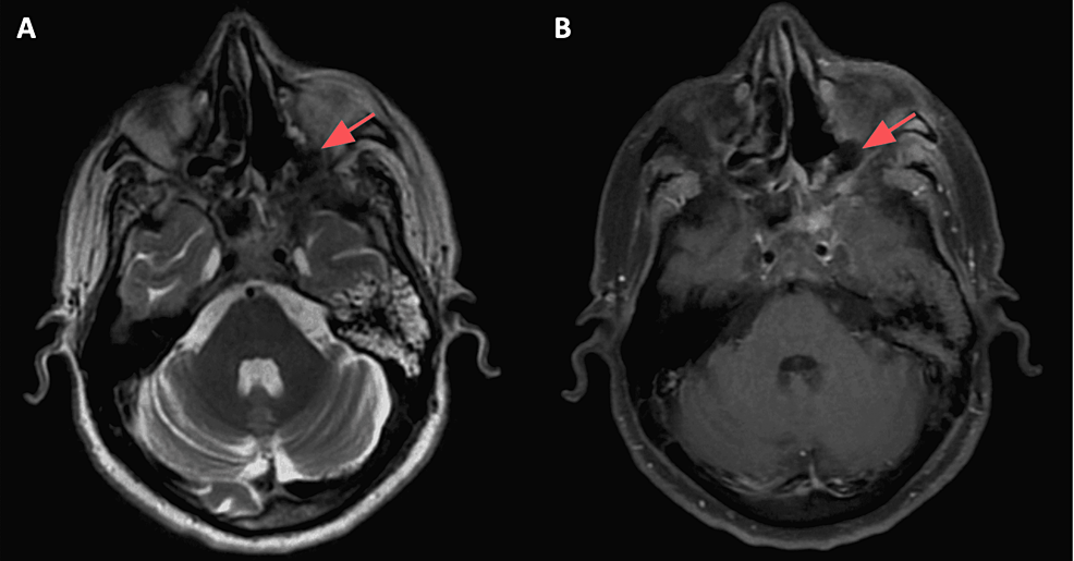 Postoperative-MRI-images:-axial-T2-(A)-and-axial-T1-(B)-with-fat-saturation-showing-resolution-of-the-mucormycosis-infection-(red-arrows-showing-the-site-of-the-previous-mucormycosis-infection).