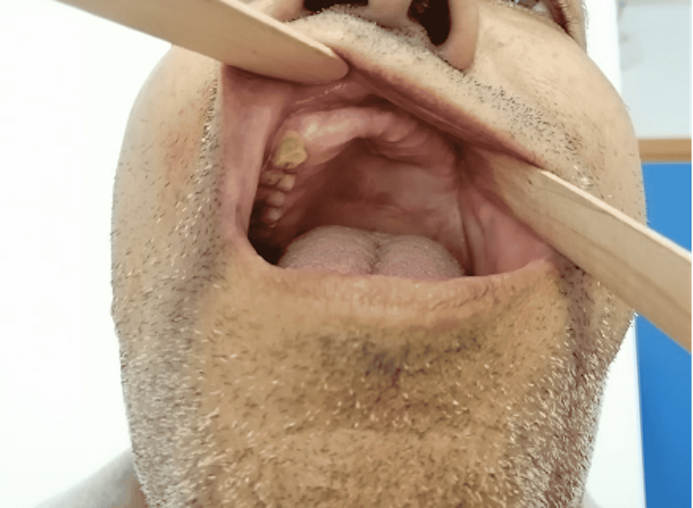 Intra-oral-exam-showing-healthy-gingiva-and-palate-postoperatively.