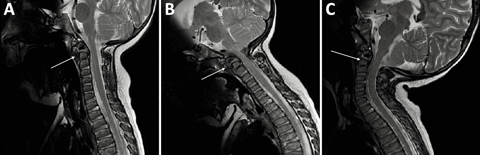 cureus-management-of-craniocervical-instability-in-spondyloepiphyseal