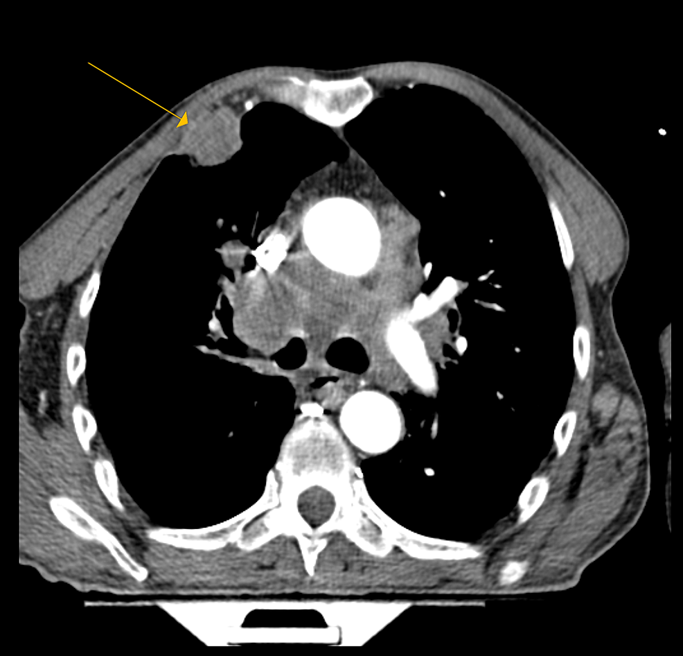 Cureus Metastatic Lung Adenocarcinoma Presenting With Hypereosinophilia