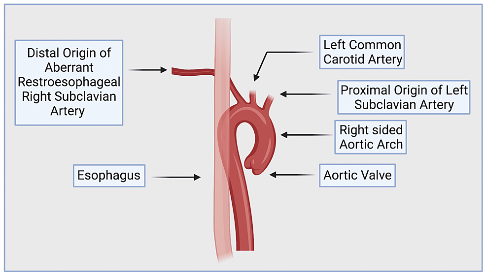 Cureus | Arteria Lusoria With Right-Sided Aortic Arch and Atrial Septal ...