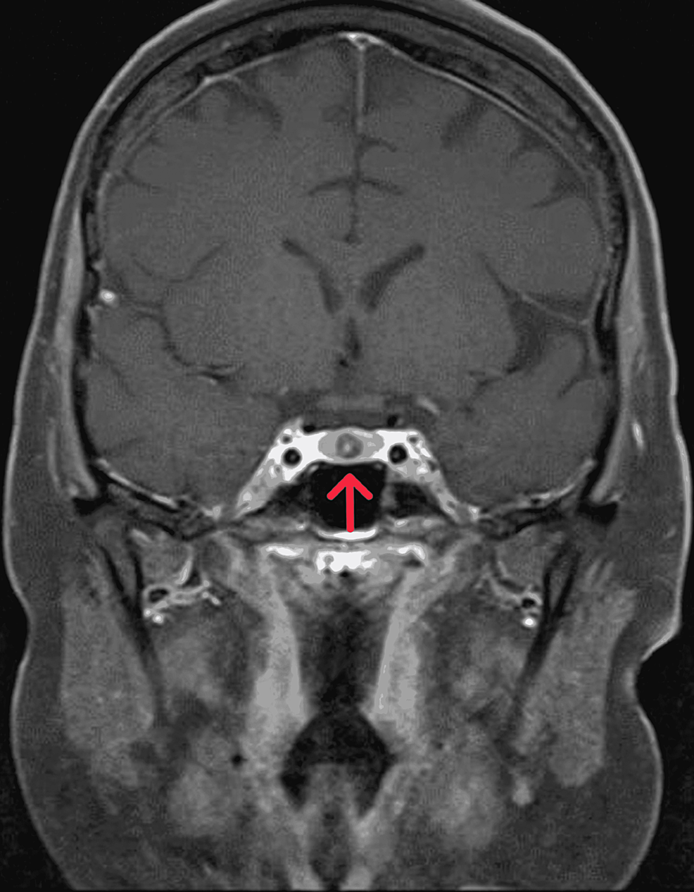 Coronal-T1-weighted-MRI-of-the-pituitary-gland-with-contrast-showed-a-hypoenhancing-nodular-lesion-at-the-midline-of-the-anterior-pituitary,-with-mild-eccentric-to-the-right