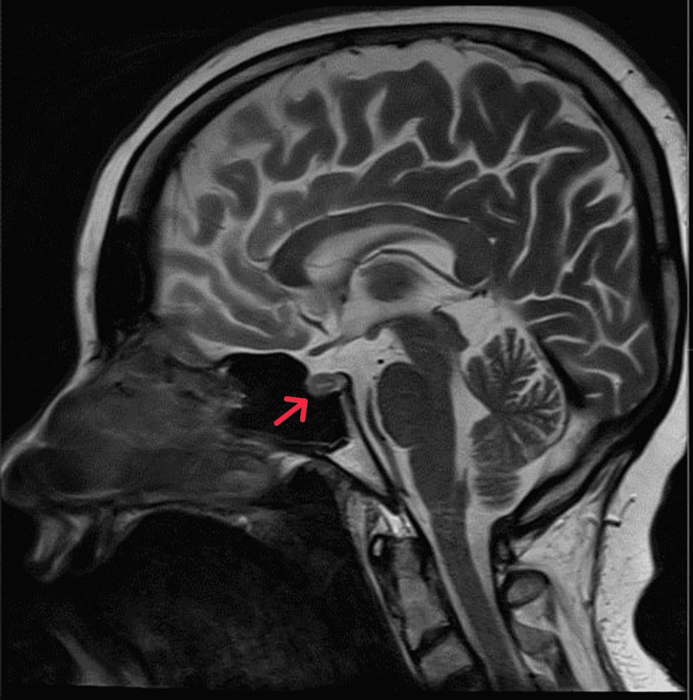 Brain-MRI-sagittal-view-showing-focal-anterior-pituitary-hypoenhancing-lesion-at-the-midline-and-eccentric-to-the-right