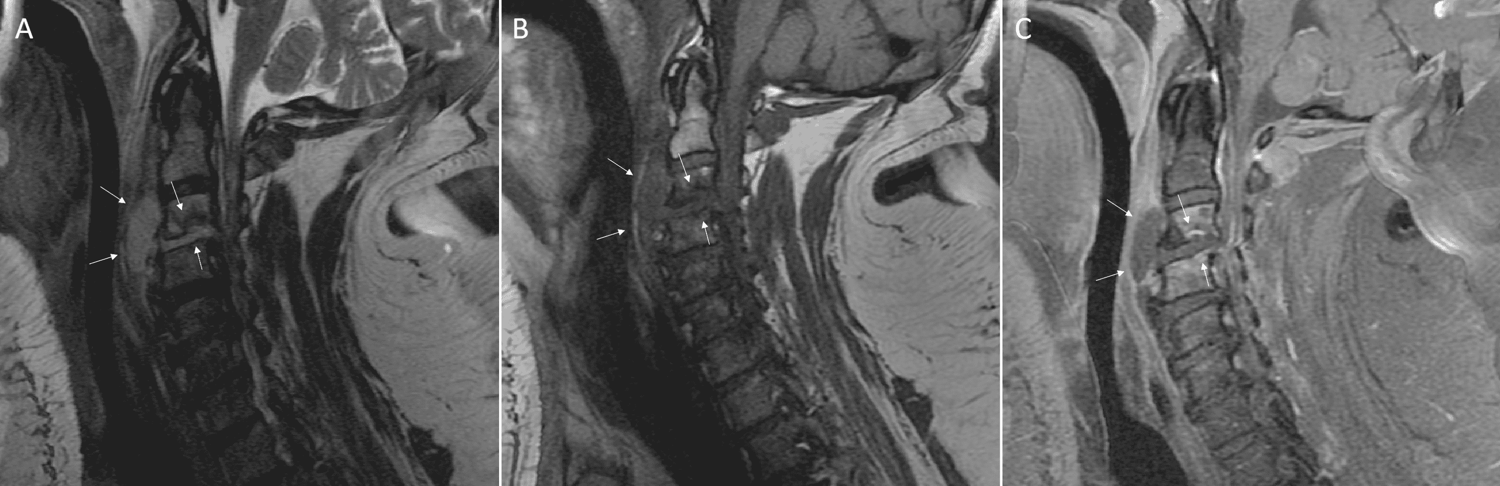 Cureus | Post-COVID-19 Infection With Meticillin-Sensitive ...