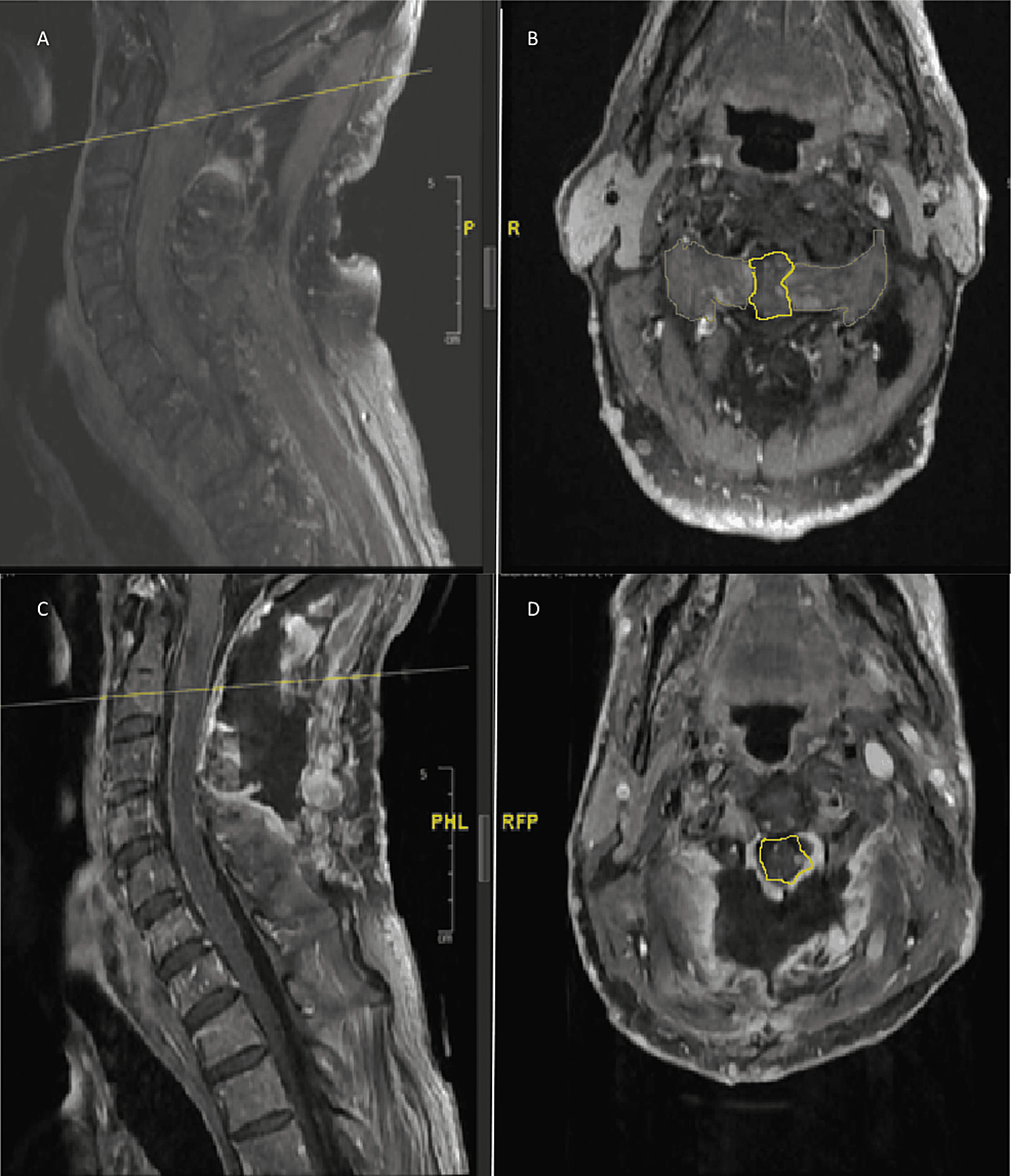 -MRI-T1-fast-Sat-post-contrast-images-of-mid-sagittal-(A)-and-axial-(B)-of-the-bilateral-neurofibromas-pre-operatively-(C)-and-post-resection-(D).