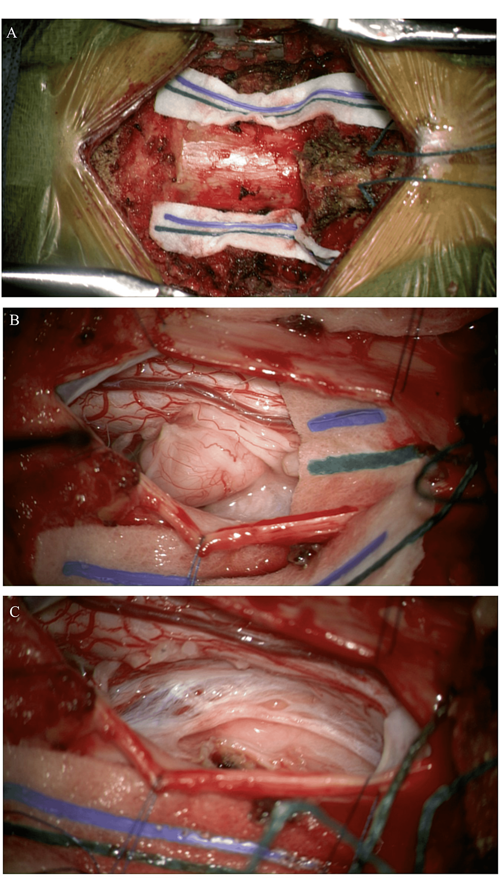 -Operative-images-after-laminectomy-and-resection-of-extradural-component.-