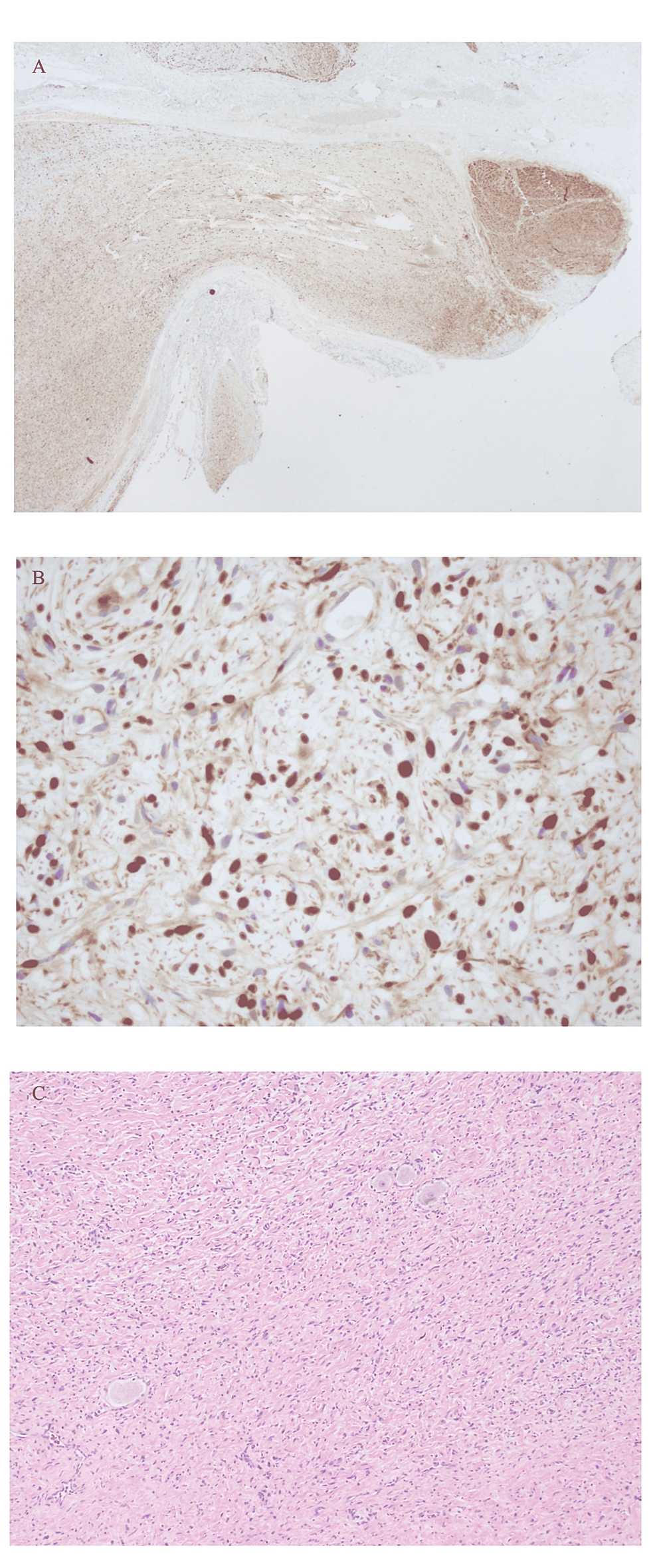 Pathology-slides-of-the-neurofibroma.