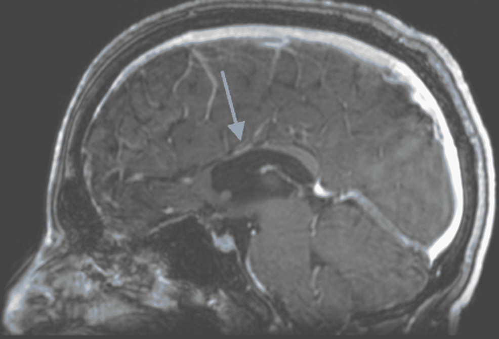 MRI-head-with-an-arrow-identifying-corpus-callosum-agenesis