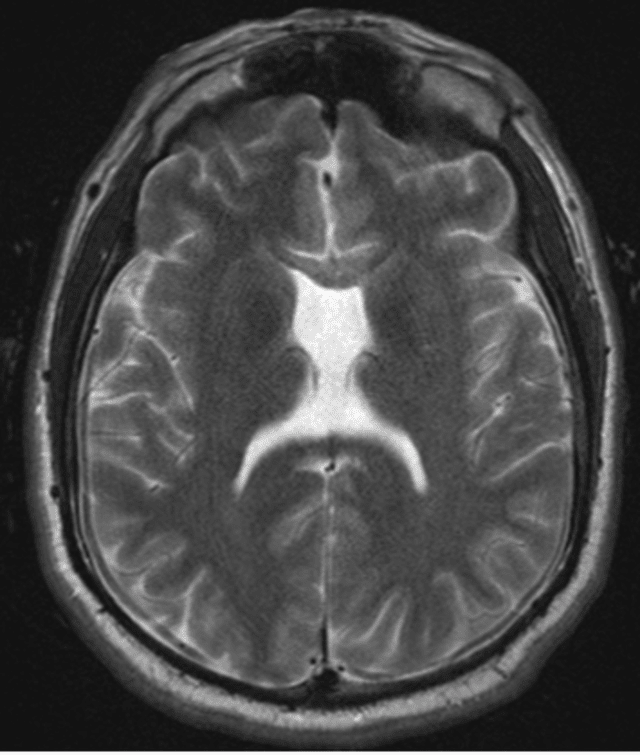 MRI-demonstrating-absent-nasal-septum-possibly-secondary-to-holoprosencephaly
