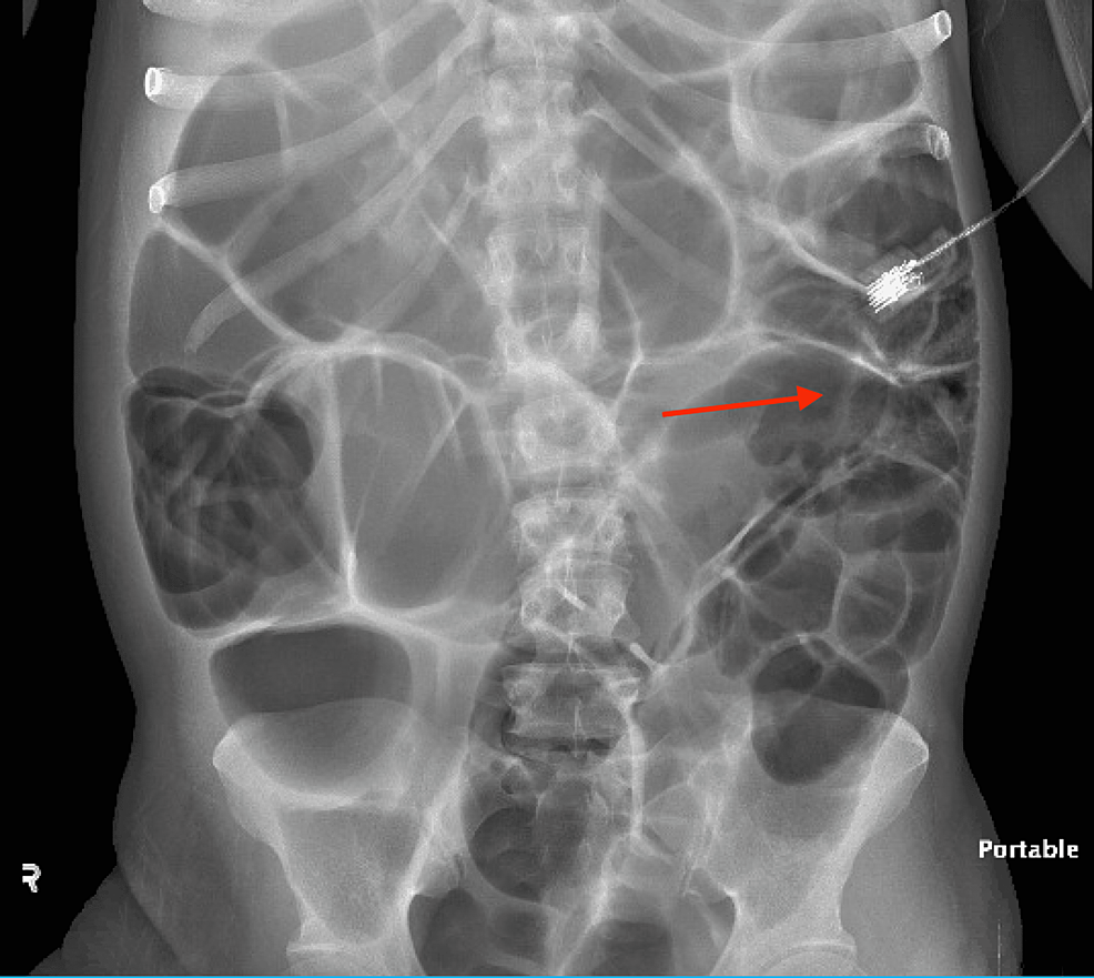 Fecal impaction, Radiology Reference Article