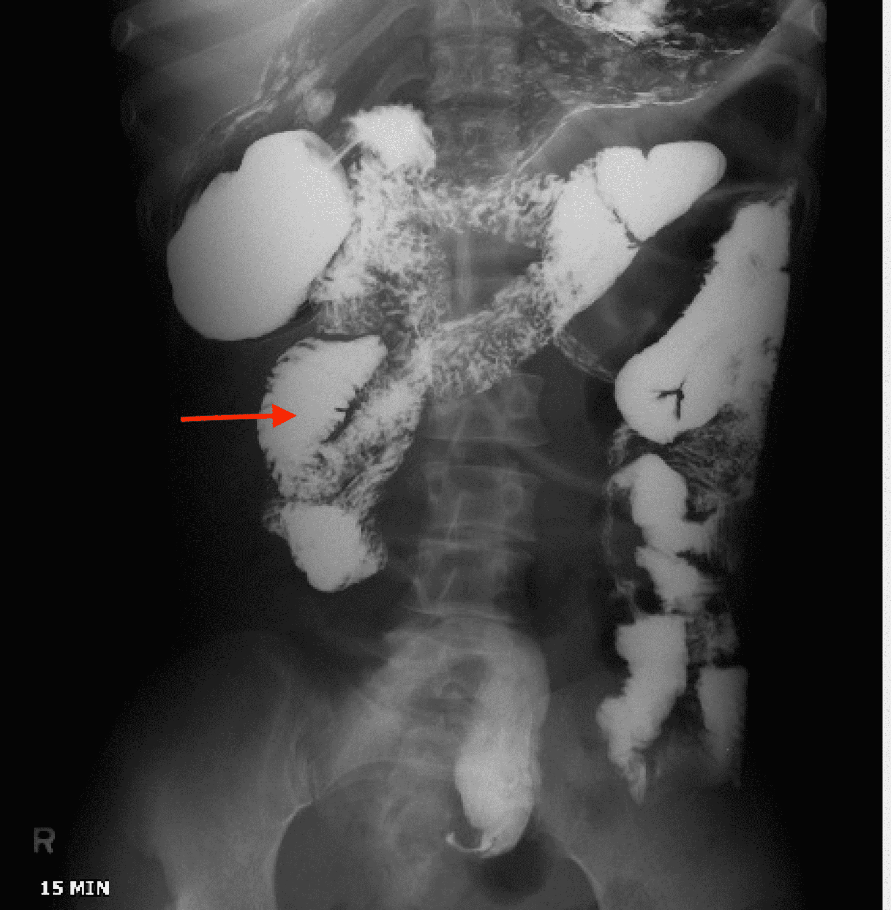 Cureus A Case of Stercoral Colitis Complicated by Ischemic Colitis in a Young Patient