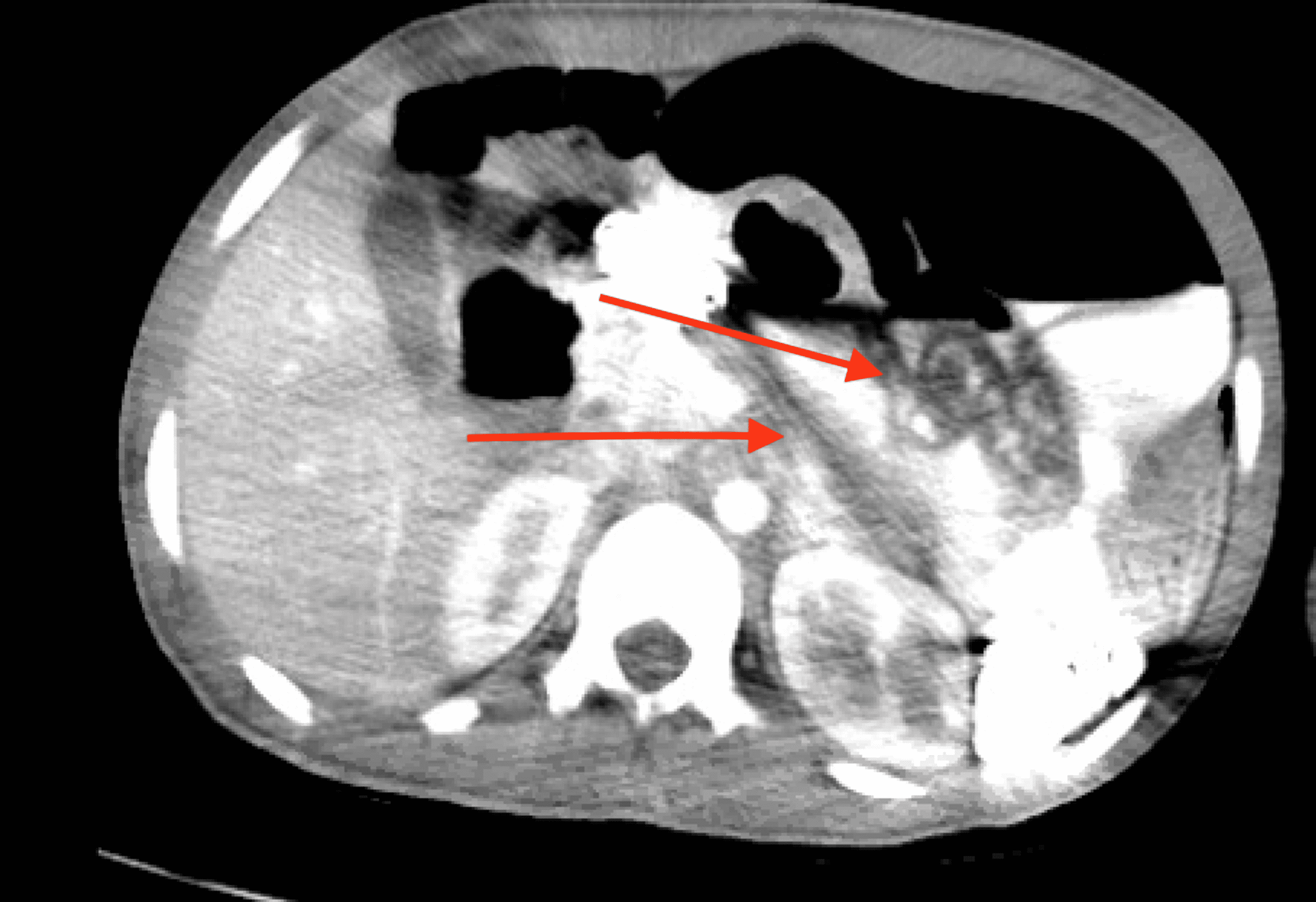 Cureus A Case of Stercoral Colitis Complicated by Ischemic Colitis in a Young Patient