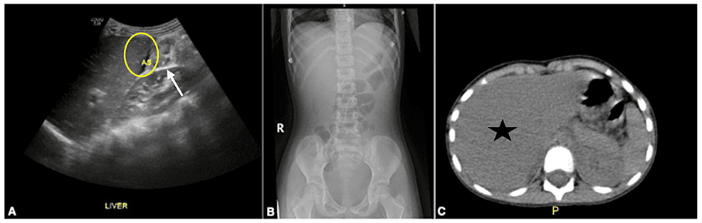 Abdominal-US-showing-small-ascites-(circle)-with-edematous-gallbladder-wall-thickening-(arrow)-(A).-Abdominal-X-ray-showing-no-significant-abnormality-(B).-CT-abdomen-with-contrast-depicting-mild-liver-enlargement-(star)-and-diffuse-intestinal-wall-thickening-(C).