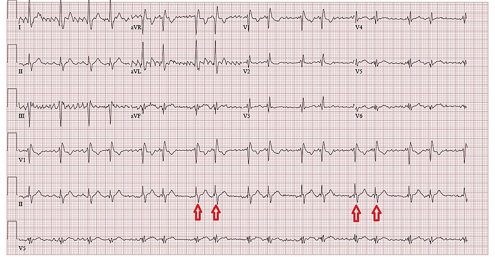 Cureus | A Partial Anomalous Pulmonary Venous Connection in a Severely ...