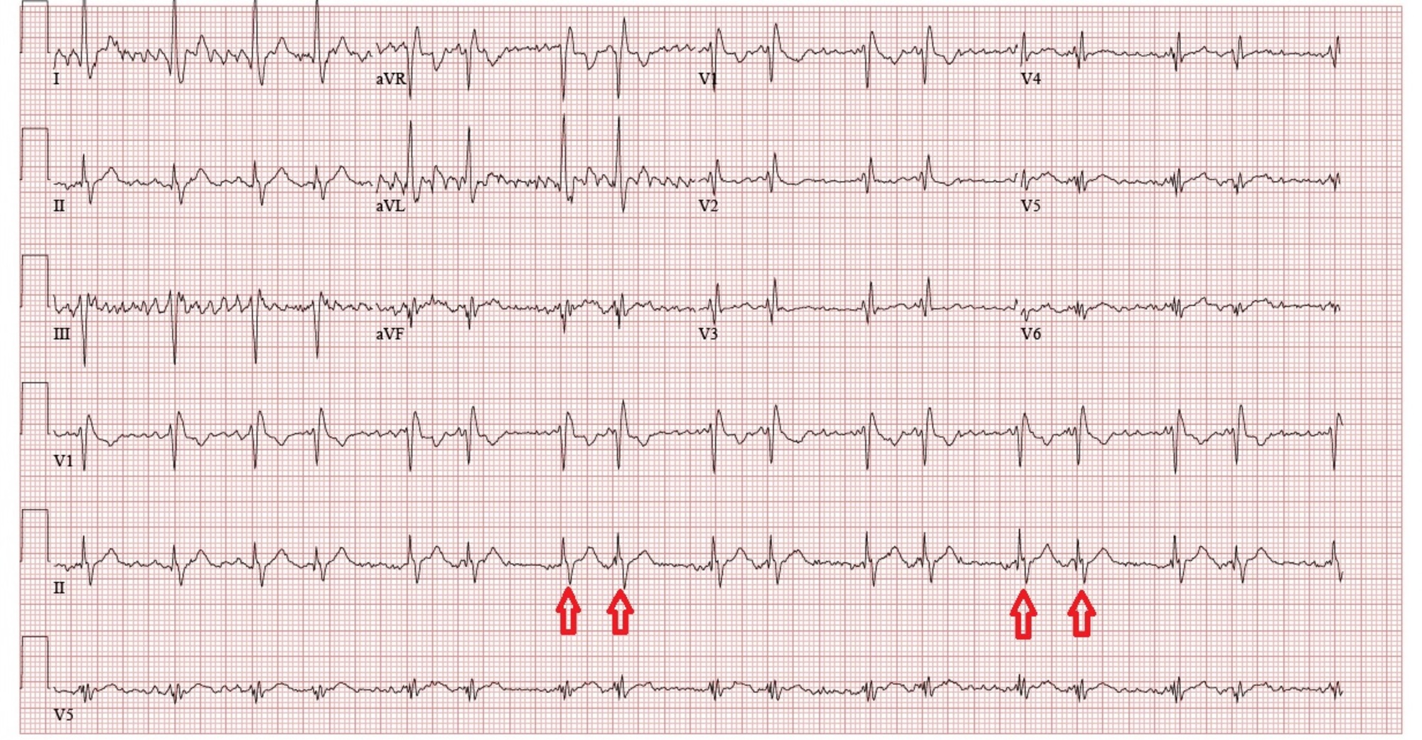 Cureus A Partial Anomalous Pulmonary Venous Connection in a Severely