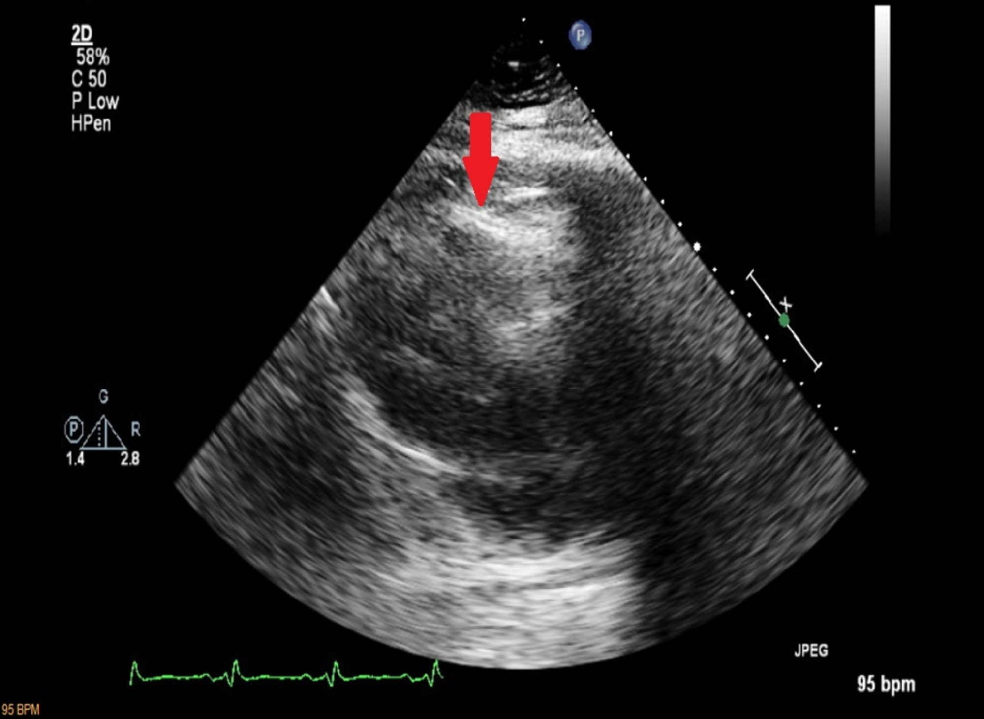 Cureus A Partial Anomalous Pulmonary Venous Connection In A Severely